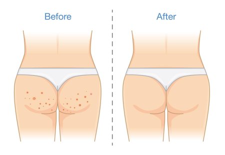 Прыщи на попе у женщин