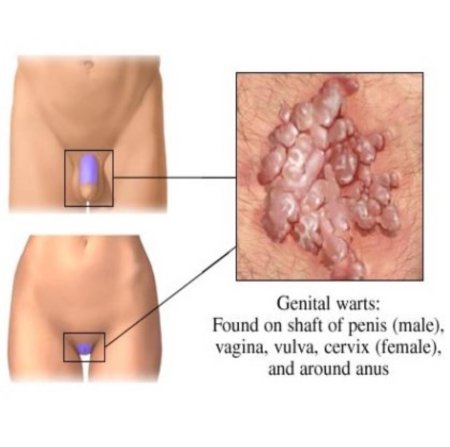 Genital wart