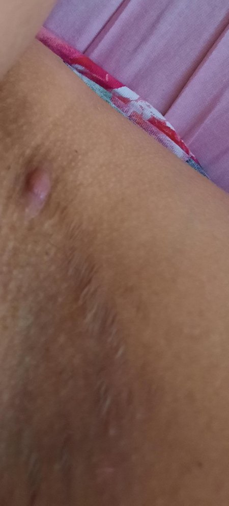 Атерома спайки