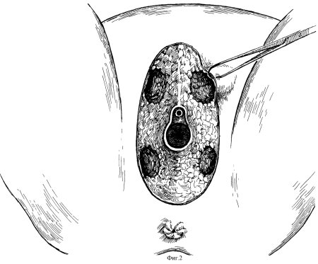 Киста бартолиниевой железы