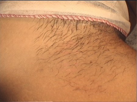 Волосы на интимной зоне