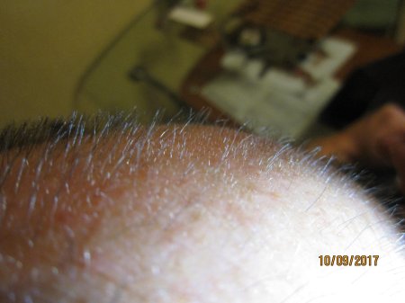 Волосы на теле