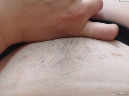 Лазерная эпиляция глубокого бикини