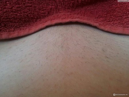 Лазерная эпиляция глубокого бикини