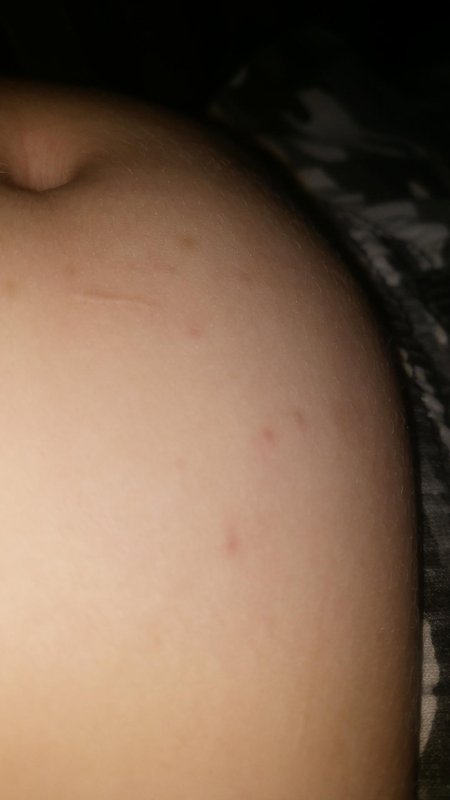 Прыщи на животе