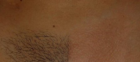 Волос на лобке