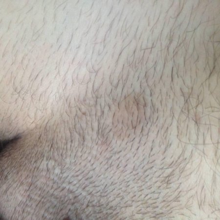 Коричневые пятна в паху у мужчин