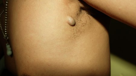 Супуративный дигидрогенит