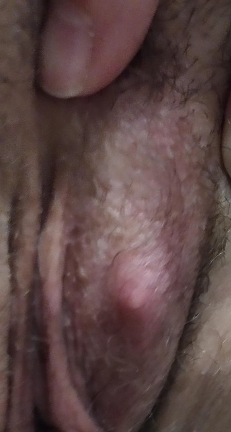 Водянистые прыщики на пенисе