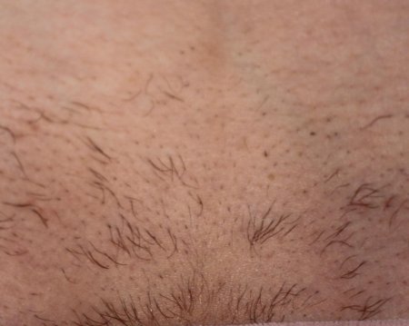 Электроэпиляция глубокого бикини