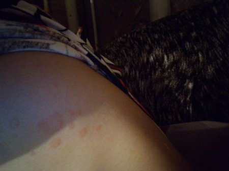 Пятна на теле