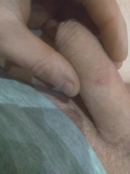 Маленькие прыщики на коже пениса