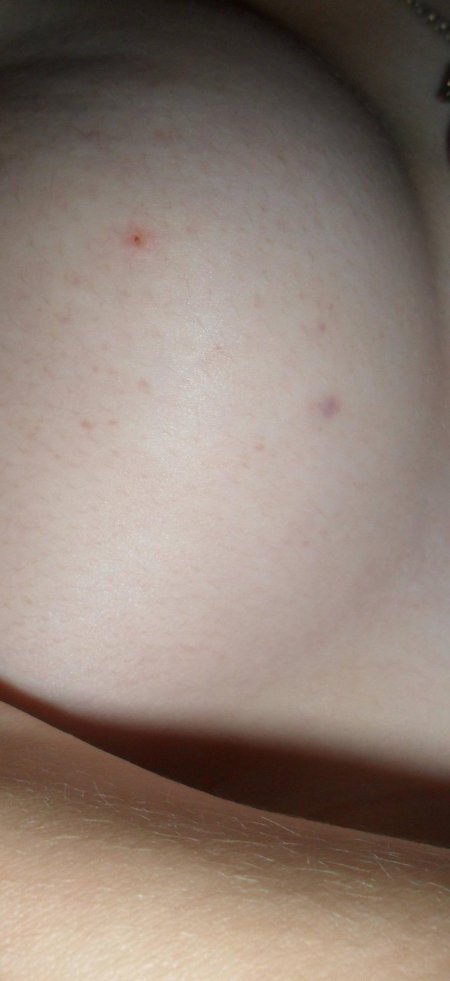 Невус на ноге