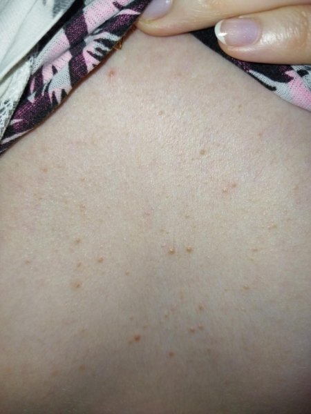 Прыщики на животе