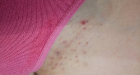 Раздражение в зоне бикини