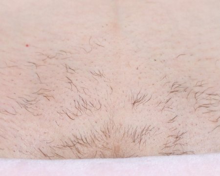 Эпидермофития межъягодичная