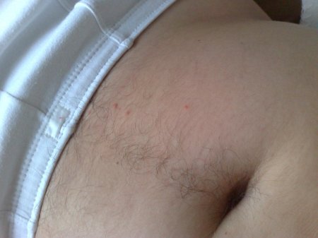 Волос на лобке