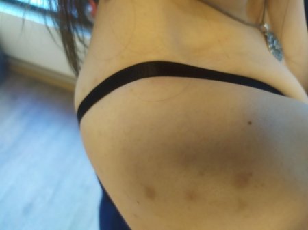 Прыщ на теле