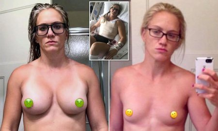 Неудачное увеличение груди