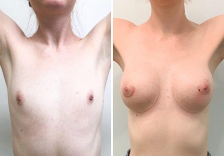Грудь после имплантации