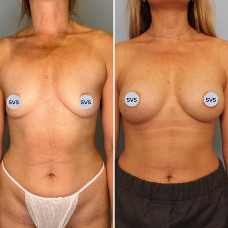 Анатомический имплант груди