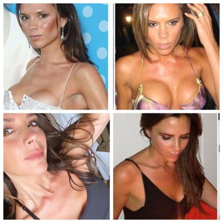 Виктория бекхэм силиконовая грудь