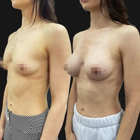 Пластическая операция груди