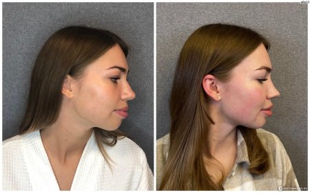 Ринопластика курносого носа