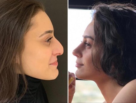 Хайбула камилович ринопластика