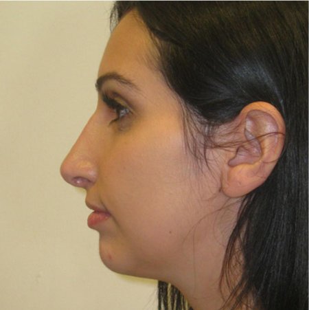 Абрамян ринопластика