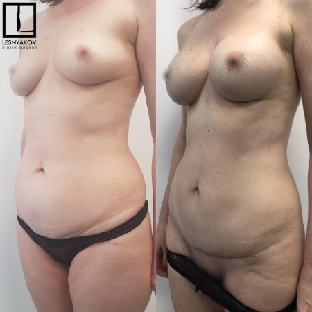 Липосакция липоскульптурирование
