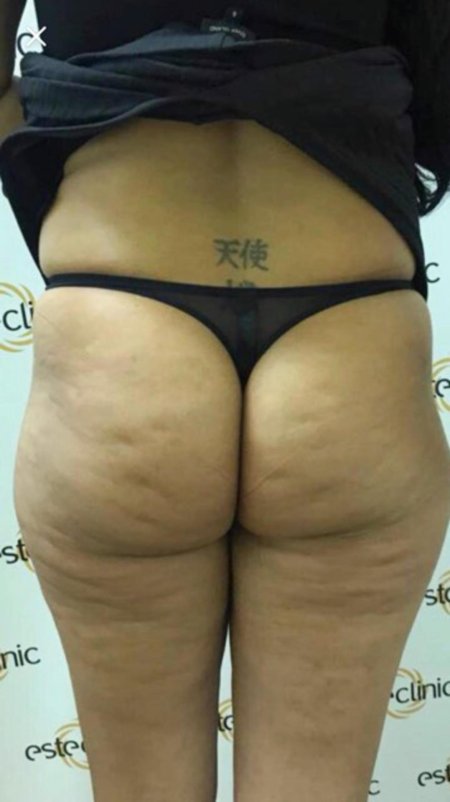 Липодистрофия целлюлит