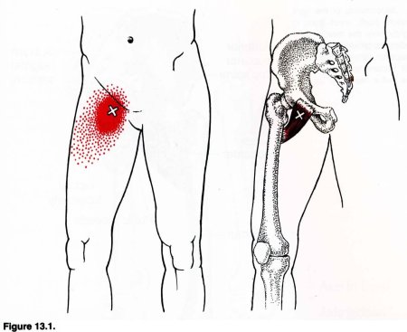 Триггерные точки мышц бедра
