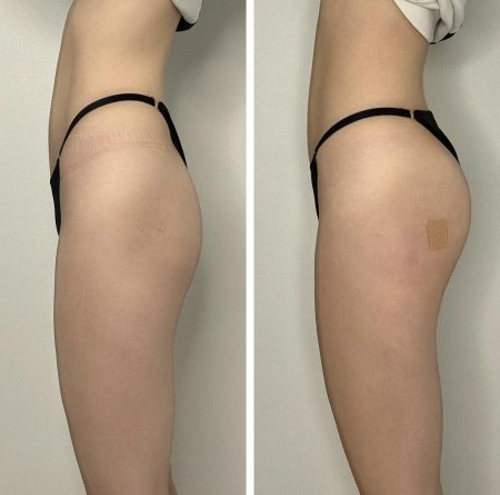 Операция по увеличению ягодиц