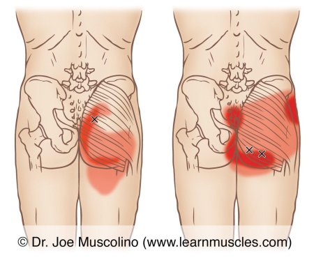 Gluteus medius trigger point