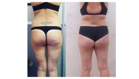 Антицеллюлитный массаж до и после сеансов