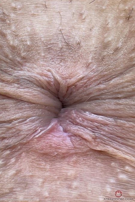 Папиллома влагалища