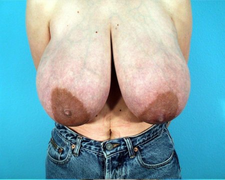 Огромная некрасивая грудь