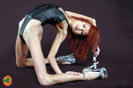 Анорексия ню