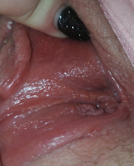 Белые пупырышки на влагалище