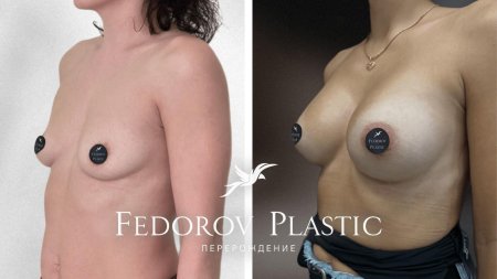 Пластика груди