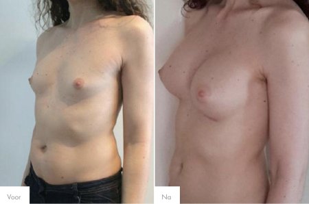 Гормональная грудь транссексуала