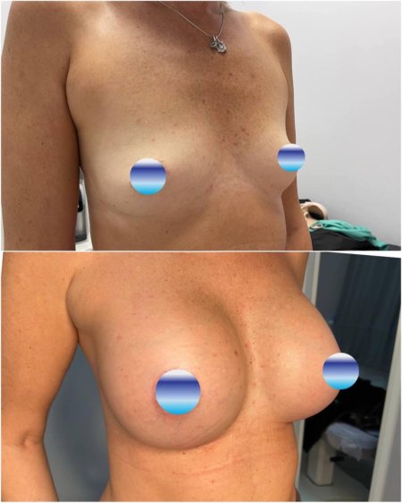 Грудь импланты