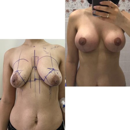 Операция по подтяжке груди