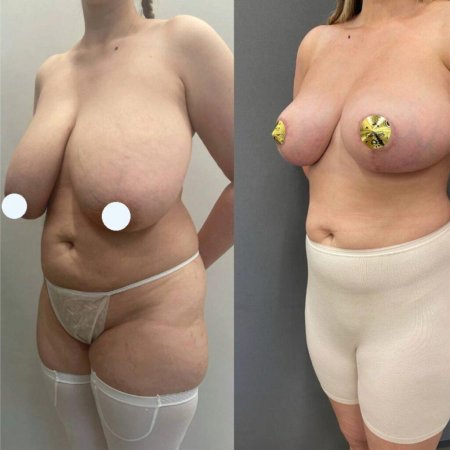 Подтяжка груди с имплантами