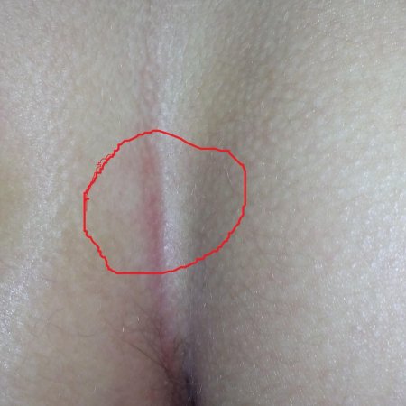 Уплотнение на копчике