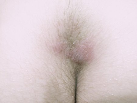 Чешется промежность у мужчин