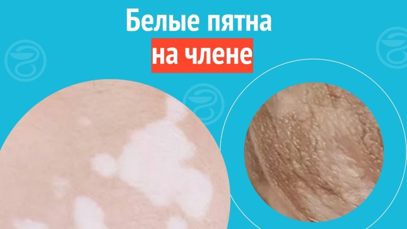 Белые пятна на половом члене