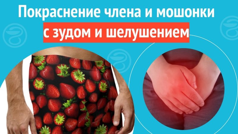 Покраснение головки полового члена