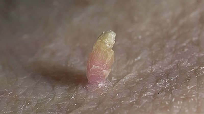 Остроконечные кондиломы condylomata acuminata